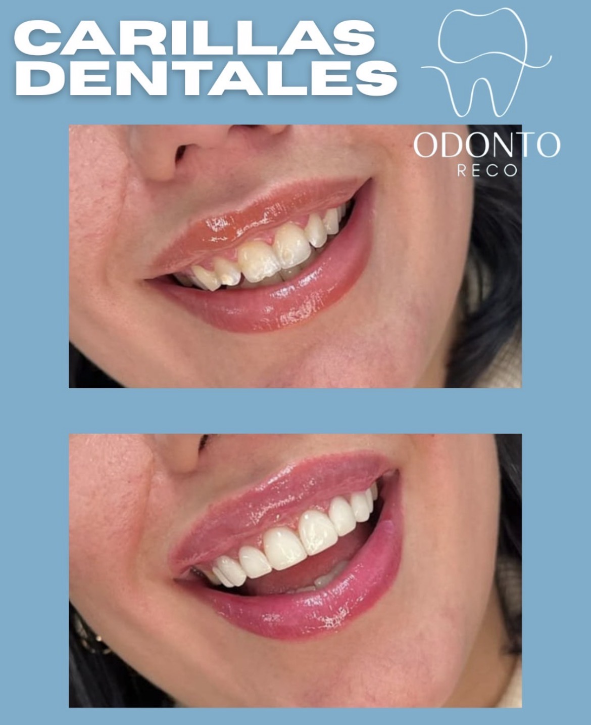 Antes y después tratamiento dental 2